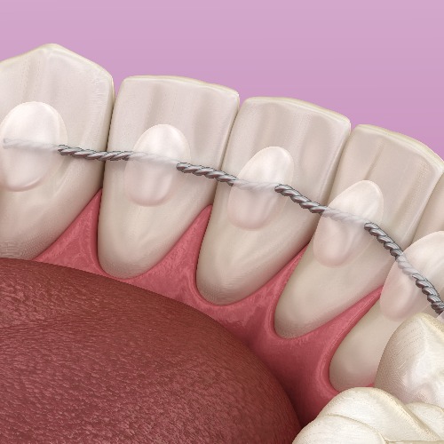 Retainers dental installed after braces treatment, Medically accurate dental 3D illustration