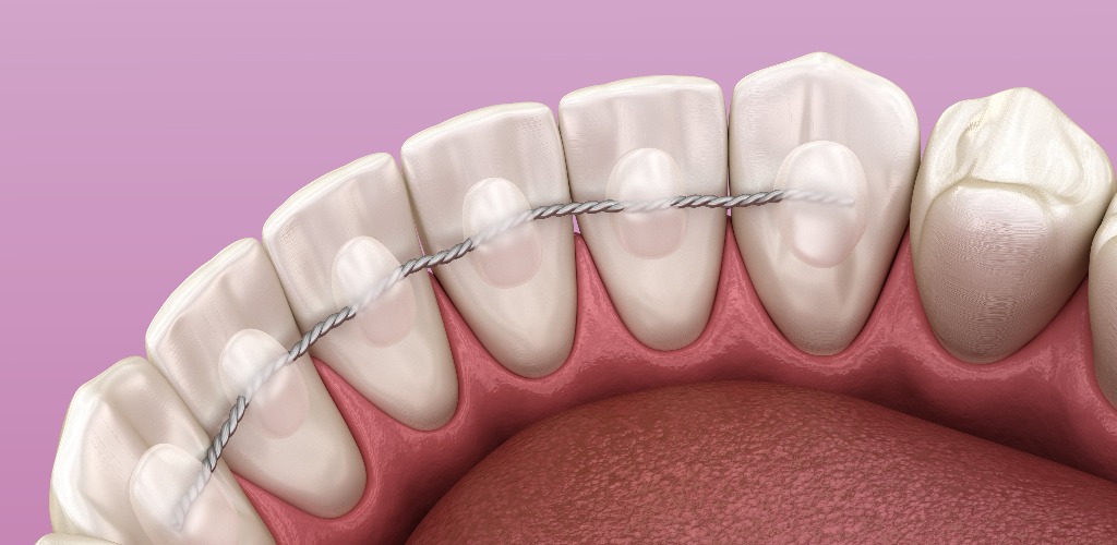 Retainers dental installed after braces treatment medically accurate dental 3d illustration jpg