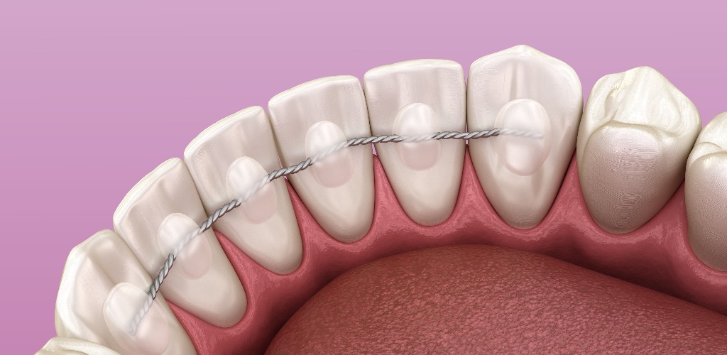 Retainers dental installed after braces treatment, Medically accurate dental 3D illustration